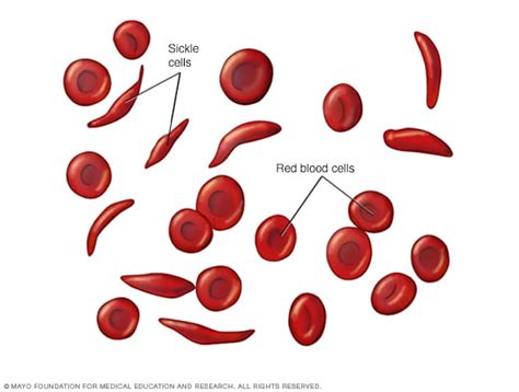 Anemia de células falciformes - Síntomas y causas - Mayo Clinic