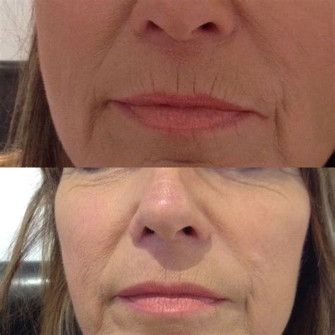 I ordered AngelLift dermastrips and have absolutely loved the effect they had on my smile lines! It's incredible the difference they make just 30 minutes a day, I truly look 5-10 years younger. Their customer service is excellent as well. I highly recommend AngelLift as a simple, safe approach to look - FEEL - much younger!.