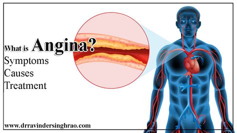 Angina: Causes, Symptoms, and Treatment Doctor Patient