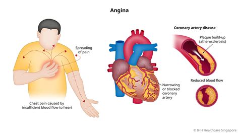 Angina smerter