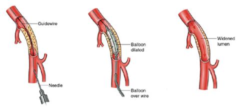 Angiogram, Angioplasty and Stents - NBT