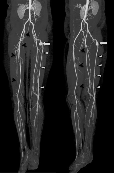 Angiographies-lower extrem & embolization - AAPC