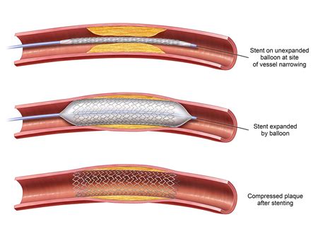 Angioplasty and Vascular Stenting - Interventional Radiology