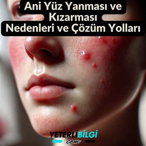 Ani Ateş Basması Ani Üşüme Yüze Ateş Basması Ve Kızarması . 