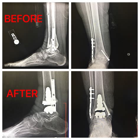 Ankle Replacement Surgery Ankle Replacement Technology