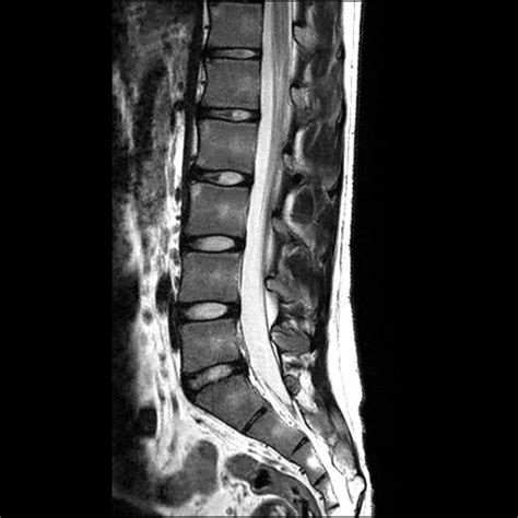 Ankylosing spondylitis presenting as gluteal enthesitis