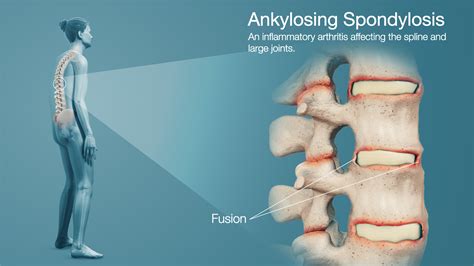 Ankylosis definition of ankylosis by Medical dictionary