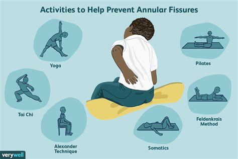 Annular Fissure: Causes, Healing, and Exercises - Verywell …