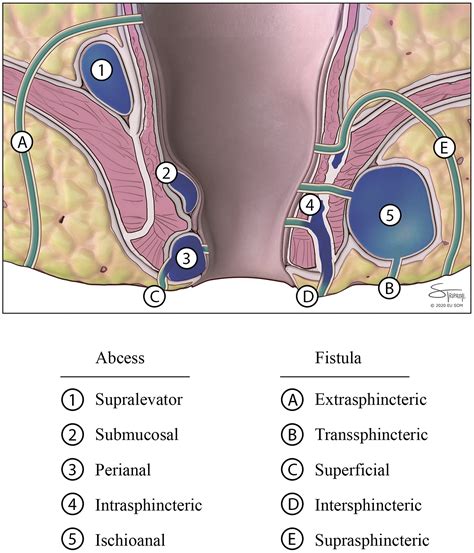 Anorectal Abscess: Practice Essentials, Anatomy, Pathophysiology - Medscape