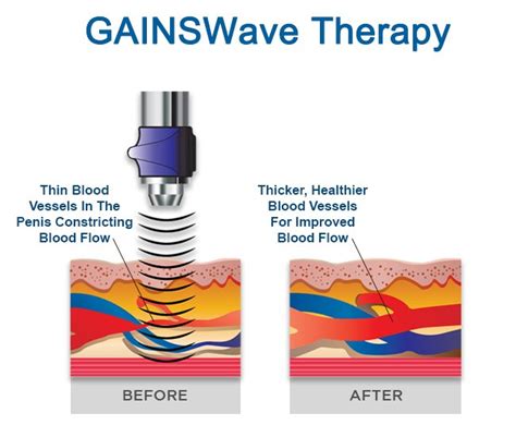 Another Kind of Gains: Treating ED with GAINSWave