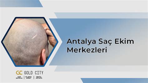 Antalyada saç ekim merkezleri