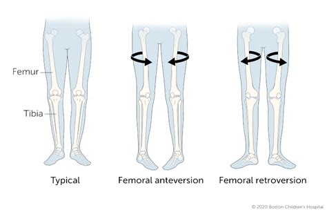 Antavarsan. Normal version is a forward angle of 12-15 degrees. In individuals with version deformities, the femoral neck may be rotated either too far forward - a condition called excessive anteversion, or too far backward, which is called retroversion. 