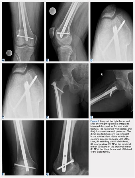 Antegrade Femoral Nail Distal Interlocking Screw Causing …