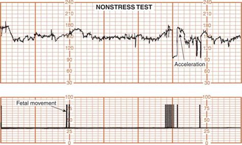 Antepartum fetal heart rate testing: IV. The nonstress test as a ...