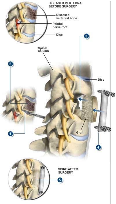 Anterior Cervical Corpectomy Spine Surgery Spine-health