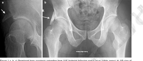 Anterior Inferior Iliac Spine (AIIS) and Subspine Hip …