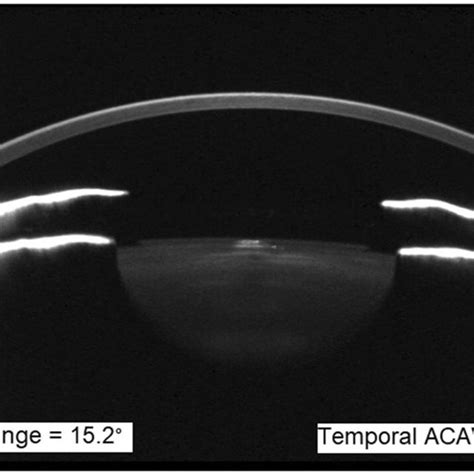 Anterior chamber angle width, central vault and intraocular pressure ...