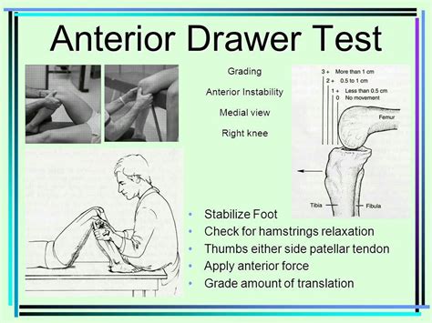 Anterior drawer test. Anterior translation of the tibia associated with a soft or a mushy end-feel indicates a positive test. More than about 2mm of anterior translation compared to the ... The diagnostic accuracy of ruptures of the anterior cruciate ligament comparing the Lachman test, the anterior drawer sign, and the pivot shift test in acute and chronic ... 