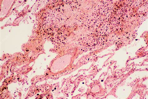 Anthracosis Stock Image C003/5120 Science Photo Library