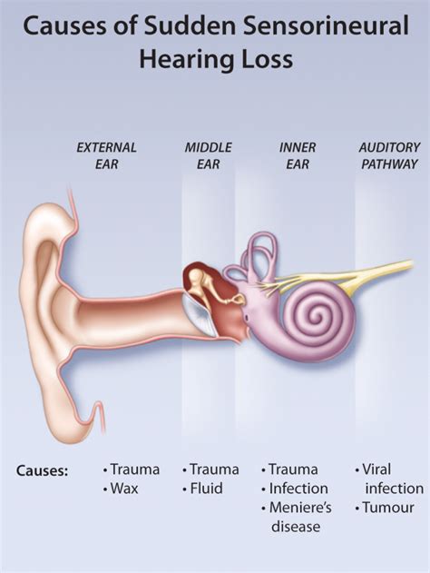 Anti Pneumonia Treatment For Sudden Hearing Loss