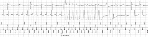 Antitachycardia Pacing Therapy - an overview ScienceDirect Topics