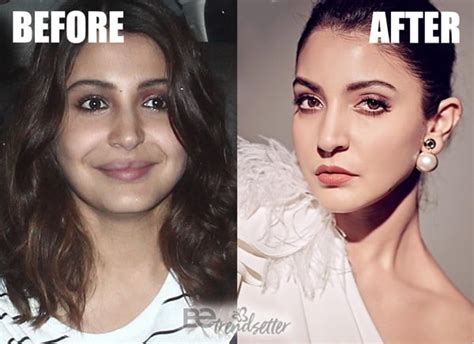 Anushka Sharma Plastic Surgery Disaster Controversy Exposed