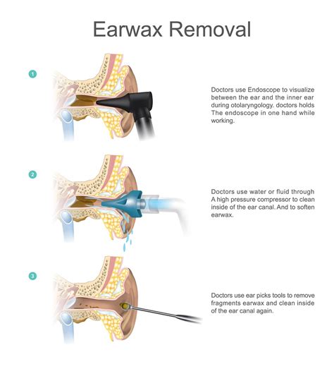 Anyone know of a place in Los Angeles to remove ear wax?