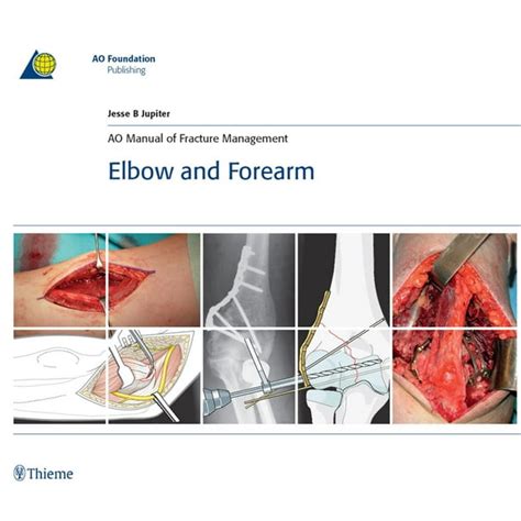 Ao manual of fracture management elbow and forearm ao publishing. - A guide to rosellas and their mutations guide to.