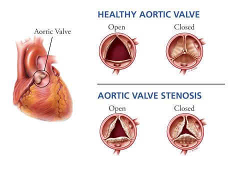 Aorta problems.  May 10, 2025 · Overview Aortic valve stenosis is a type o...