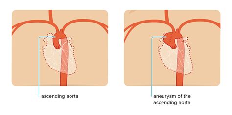 Aorta spricker