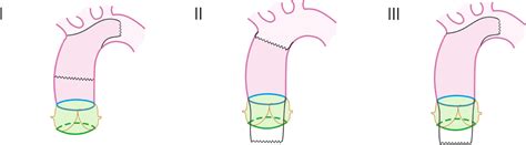 Aortic Intimo-intimal Intussusception: A Pooled Analysis …