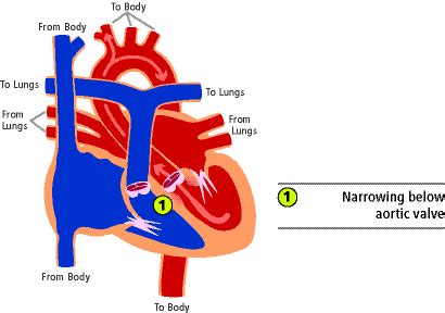 Aortic Stenosis in Children CS Mott Children