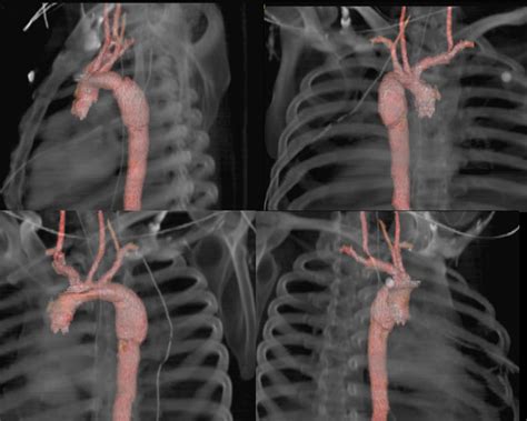 Aortic Transection - StatPearls - NCBI Bookshelf