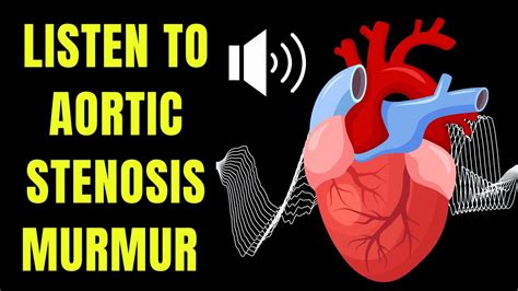 Aortic stenosis murmur. Aortic Stenosis - Physical Exam | Learn the Heart - Healio 