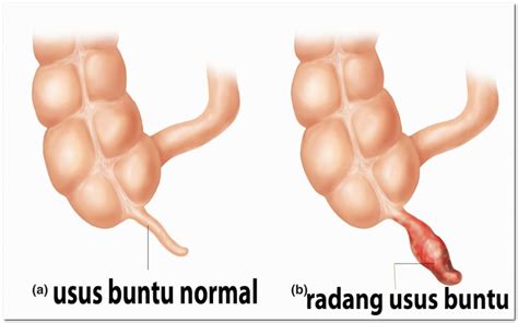 Apakah radang usus buntu tidak bisa kentut. .  <a href=https://prof.rosk...