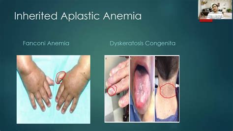 Aplastic Anemia Patient & Family Handbook