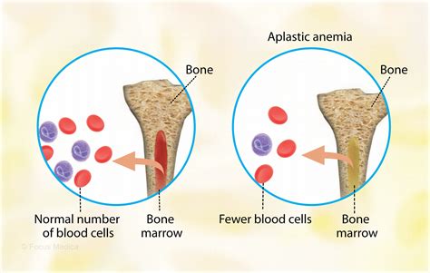 Aplastic Anemia in Children - Health Encyclopedia - University of ...