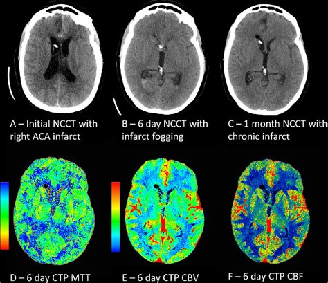 Appearance of cerebral infarct fogging on CT perfusion