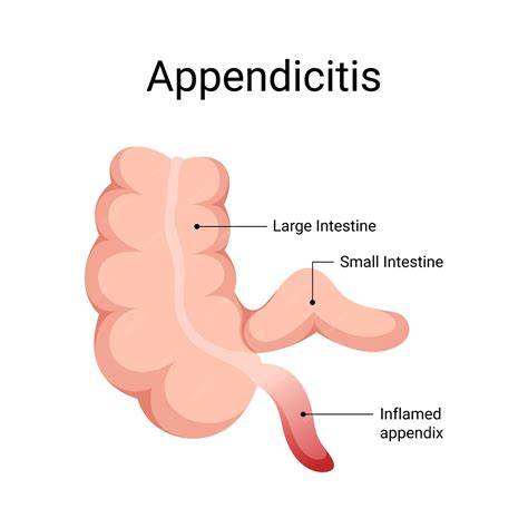 Appendicitis