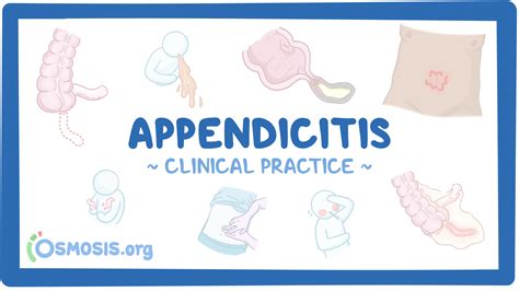 Appendicitis Cheat Sheet Medical eStudy