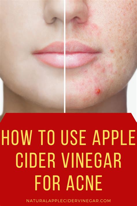 Apple Cider Vinegar for Acne: How to Use It, Safety, and More