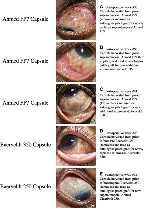 Aqueous Shunt Revision with Autologous Capsular Patch Graft: …