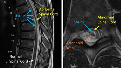 Arachnoid Web Spinal Surgery LaptrinhX