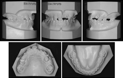 Archwire Shift Pocket Dentistry