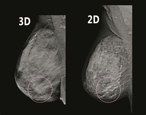 Are 3D mammograms better than standard imaging? A diverse study aims to find out