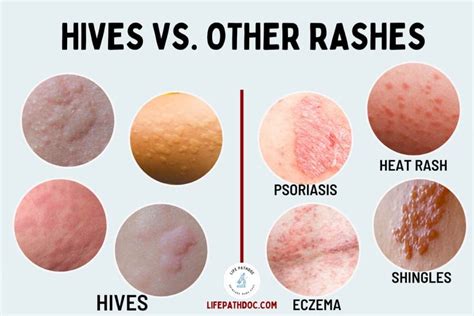 Are Hives and Rash the Same Thing? - MedicineNet