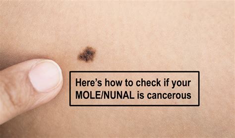 Are Melanomas Flat Or Raised - HealthySkinWorld.com