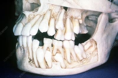 Are babies born with all their teeth in their skull?