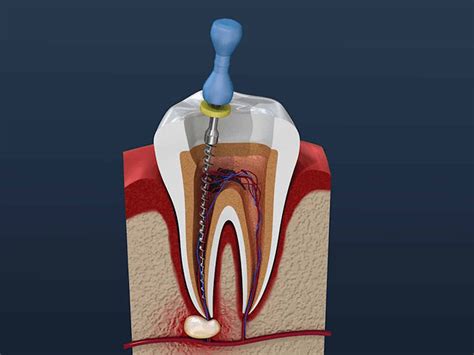 30 nov. 2022 ... I ended up seeing an endodontist and paying out of pocket, $300 for consultation+imaging and $1000 for the root canal procedure. Prices for root .... 