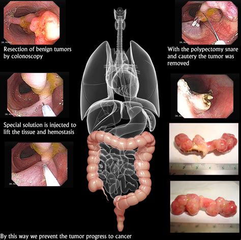 Are there physical problems that can be found via colonoscopy